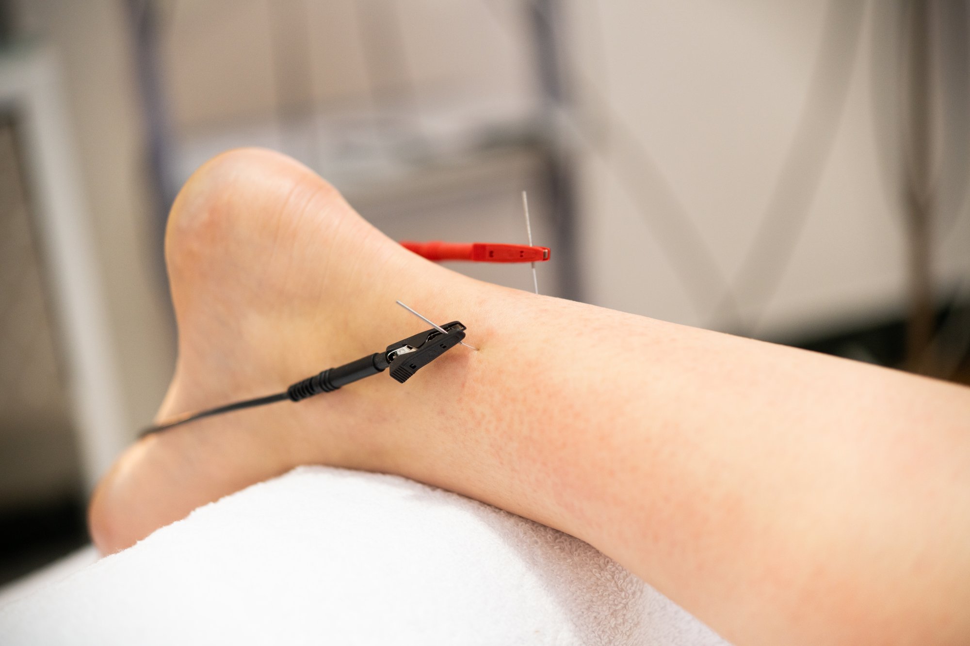 Dry needling rehab