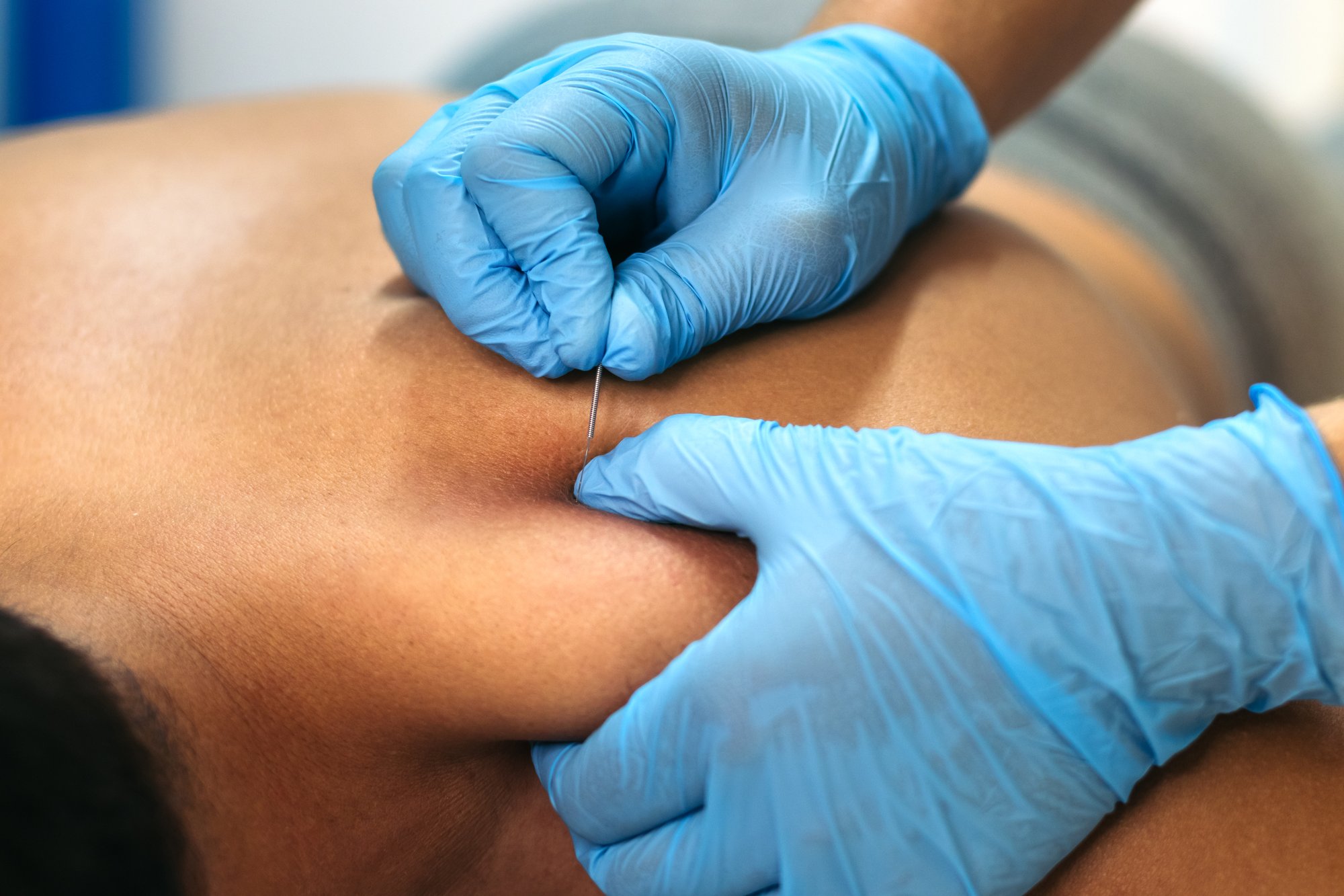 Dry Needling Treatment