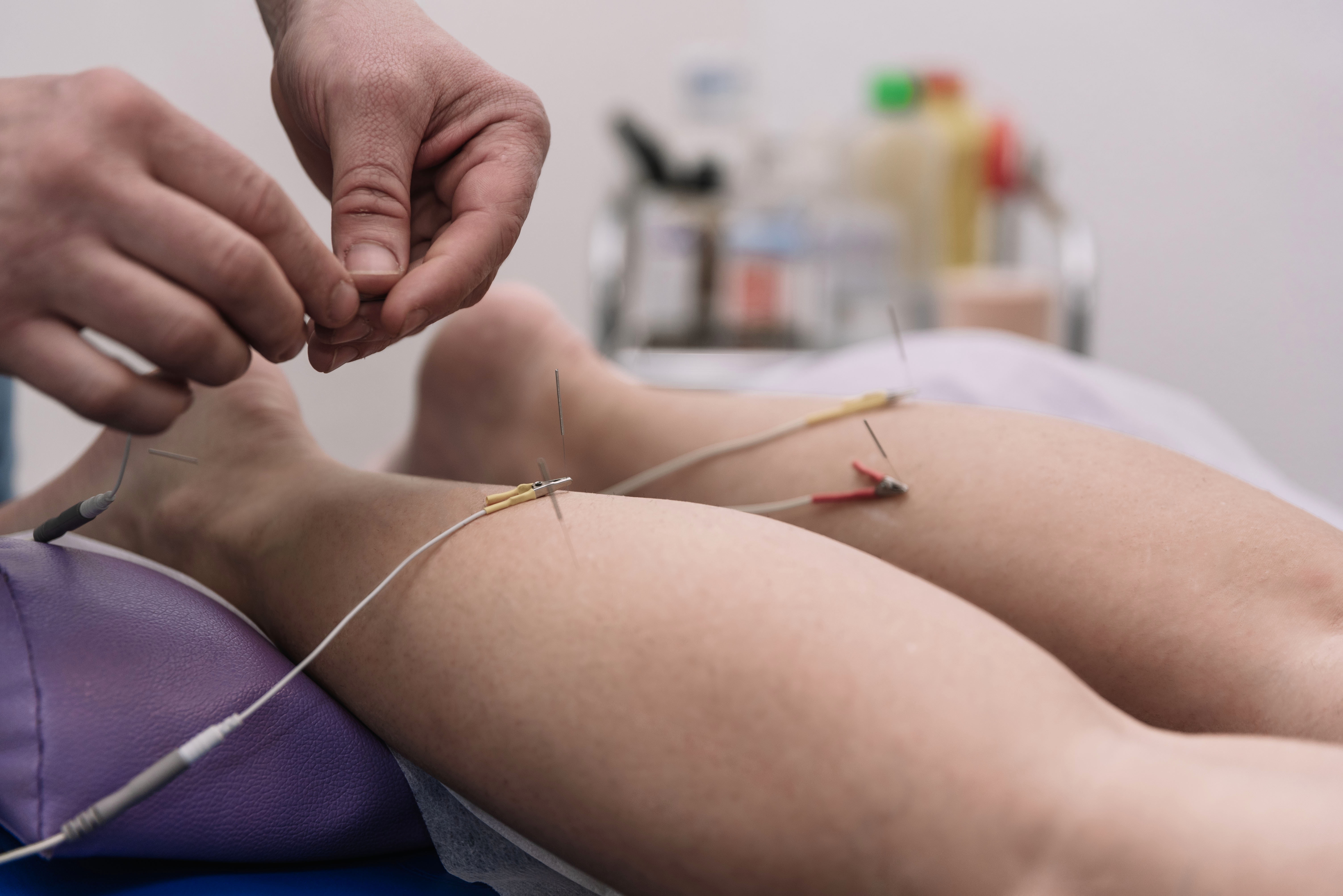 Dry Needling Physical Therapy